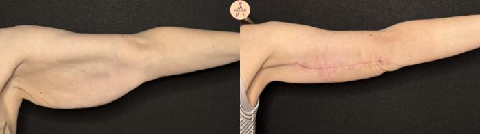 Before & After Arm Lift Case 388 Left Side View in San Antonio, Texas