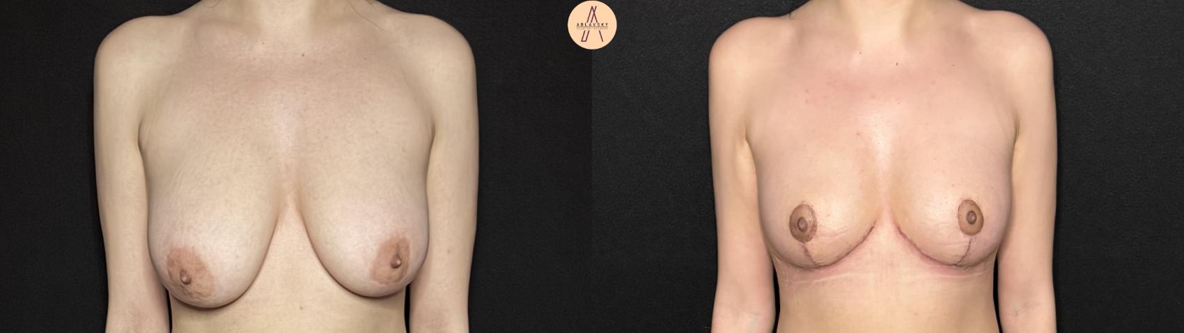Before & After Breast Reduction Case 377 Front View in San Antonio, Texas
