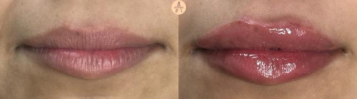 Before & After Lip Filler Case 409 Relaxed View in San Antonio, Texas