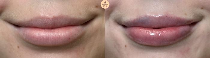 Before & After Lip Filler Case 410 Front View in San Antonio, Texas
