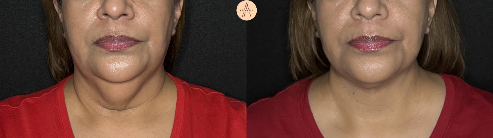 Before & After Facelift & Neck Lift Case 363 Front View in San Antonio, Texas