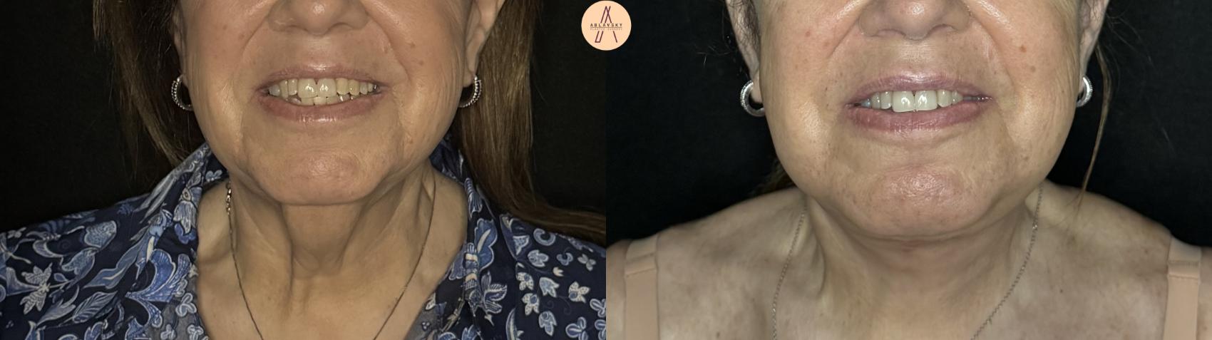 Before & After Facelift & Neck Lift Case 387 Front View in San Antonio, Texas