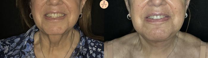 Before & After Facelift & Neck Lift Case 387 Front View in San Antonio, Texas