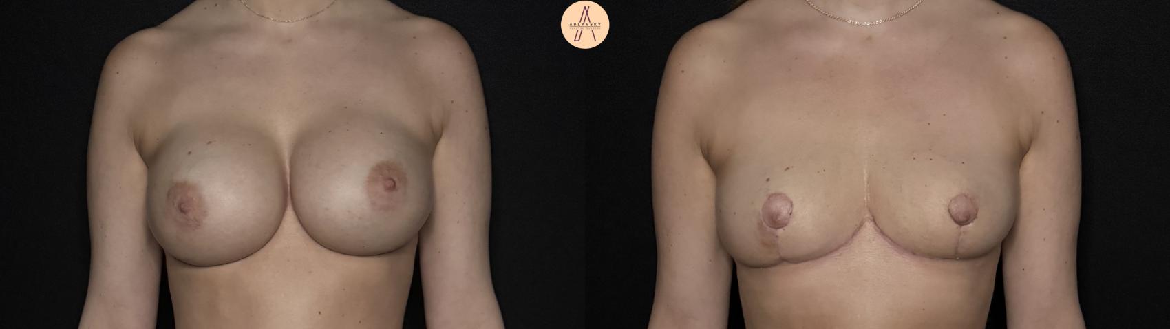 Before & After Implant removal w/ auto augmentation Case 365 Front View in San Antonio, Texas