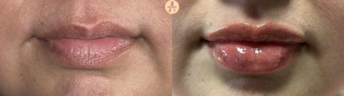 Before & After Lip Filler Case 406 Front View in San Antonio, Texas