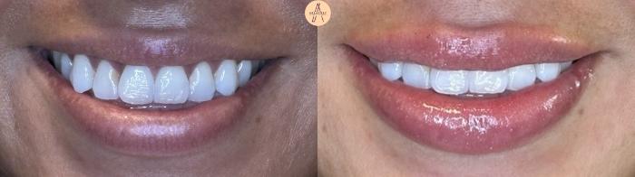 Before & After Lip Filler Case 407 Smile View in San Antonio, Texas