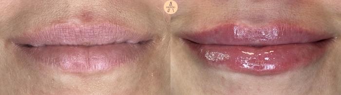 Before & After Lip Filler Case 408 Smile View in San Antonio, Texas