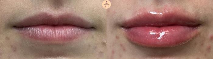 Before & After Lip Filler Case 411 Relaxed View in San Antonio, Texas