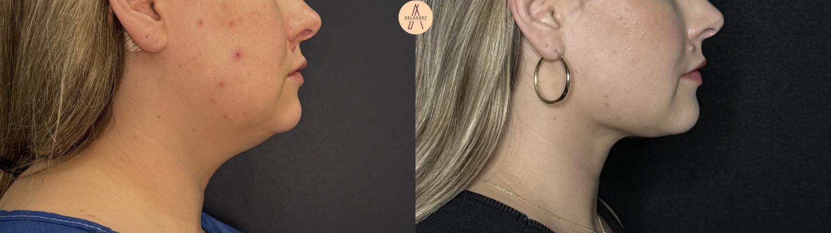 Before & After Liposuction Case 360 Right Side View in San Antonio, Texas