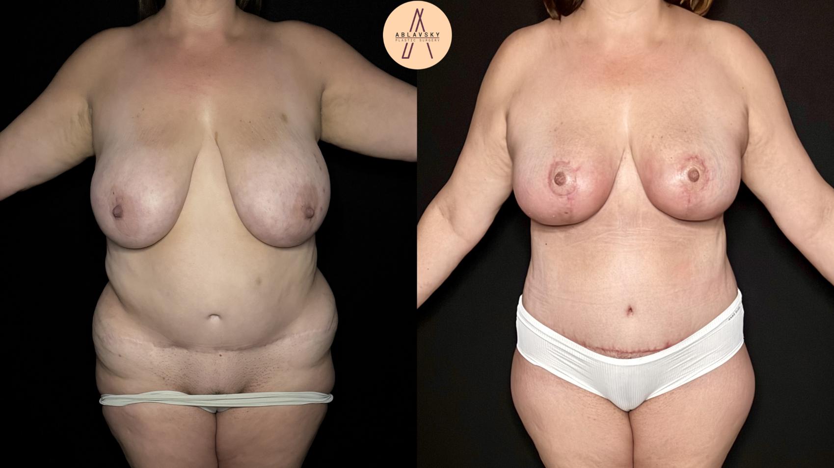 Before & After Mommy Makeover Case 367 Front View in San Antonio, Texas