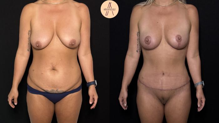 Before & After Liposuction Case 413 Front View in San Antonio, Texas