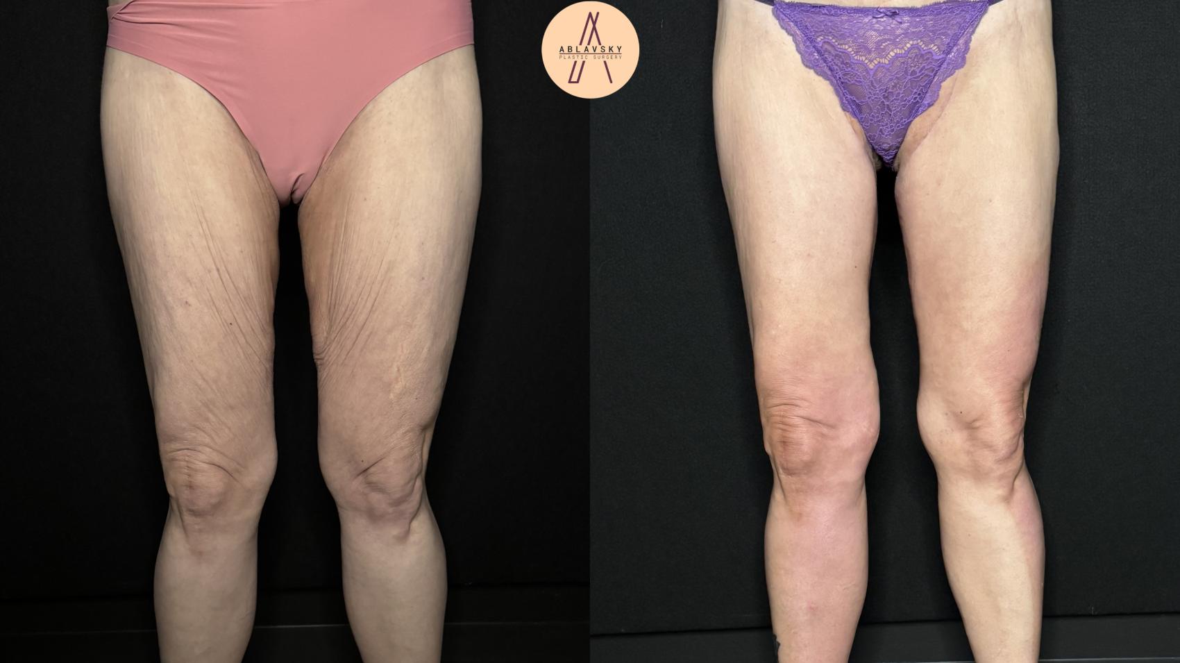Before & After Thigh Lift Case 383 Front View in San Antonio, Texas
