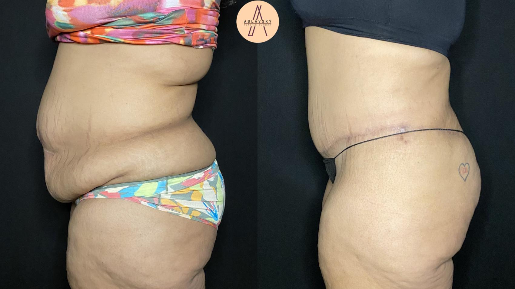 Before & After Tummy Tuck Case 345 Left Side View in San Antonio, Texas
