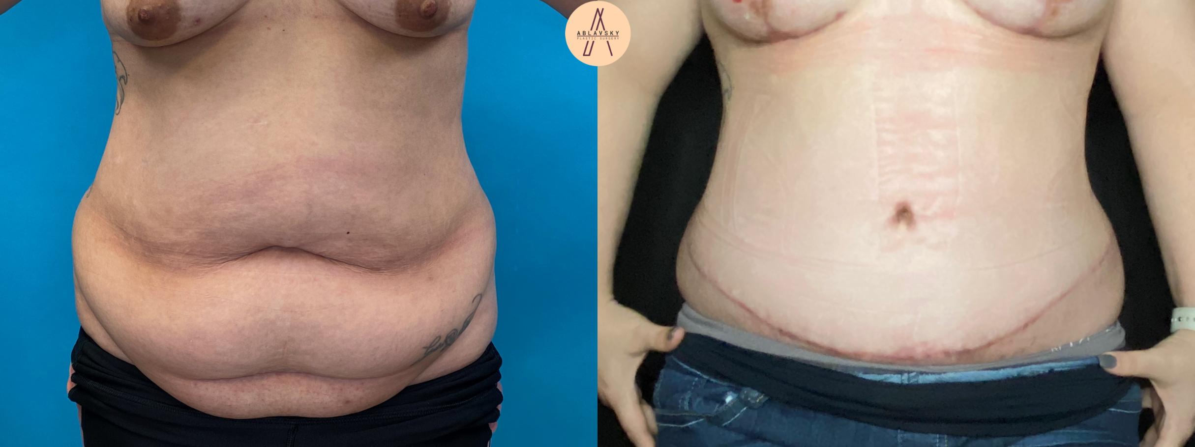 Before & After Breast Lift Case 36 Front View in San Antonio, Texas