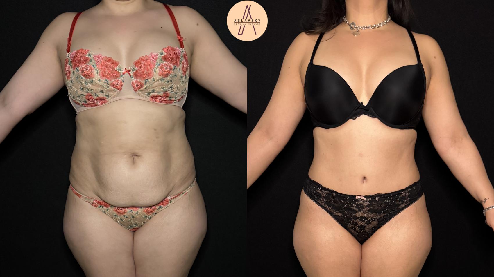 Before & After Liposuction Case 369 Front View in San Antonio, Texas