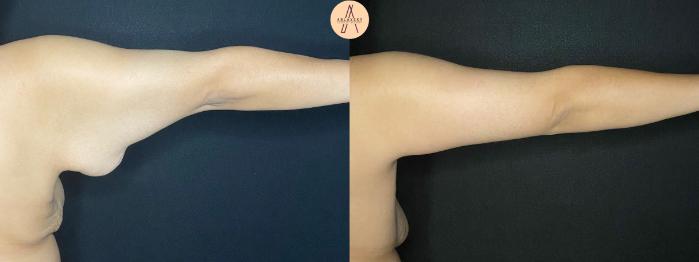 Before & After Arm Lift Case 100 Back right  View in San Antonio, Texas