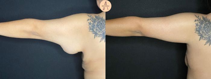 Before & After Arm Lift Case 100 Left back View in San Antonio, Texas