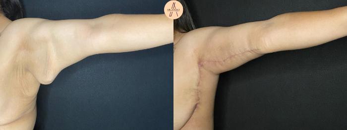 Before & After Arm Lift Case 100 Left Oblique View in San Antonio, Texas