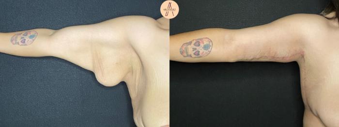 Before & After Arm Lift Case 100 Right Oblique View in San Antonio, Texas