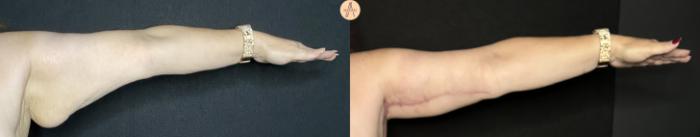 Before & After Arm Lift Case 229 Front View in San Antonio, Texas