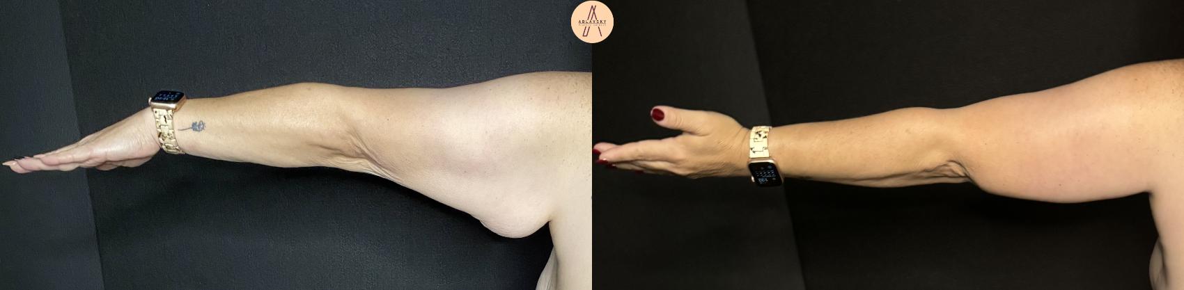 Before & After Arm Lift Case 229 Left Back View in San Antonio, Texas