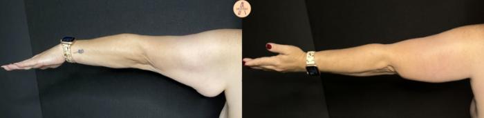 Before & After Arm Lift Case 229 Left Back View in San Antonio, Texas