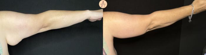 Before & After Arm Lift Case 229 Right Back View in San Antonio, Texas