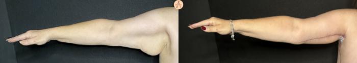 Before & After Arm Lift Case 229 Right Side View in San Antonio, Texas