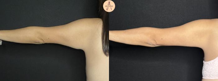 Before & After Arm Lift Case 255 Back Left View in San Antonio, Texas