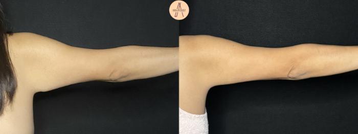 Before & After Arm Lift Case 255 Back Right View in San Antonio, Texas