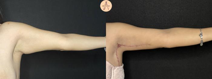 Before & After Arm Lift Case 255 Left Side View in San Antonio, Texas