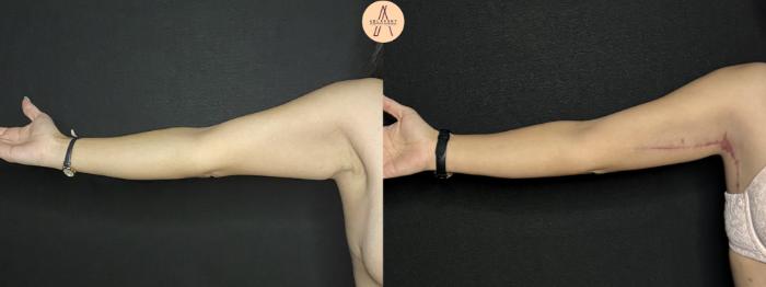 Before & After Arm Lift Case 255 Right Side View in San Antonio, Texas