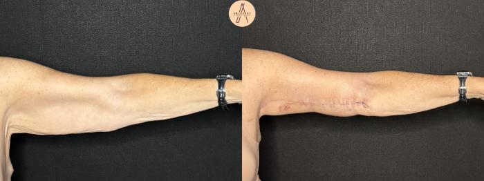 Before & After Arm Lift Case 281 Left Side View in San Antonio, Texas