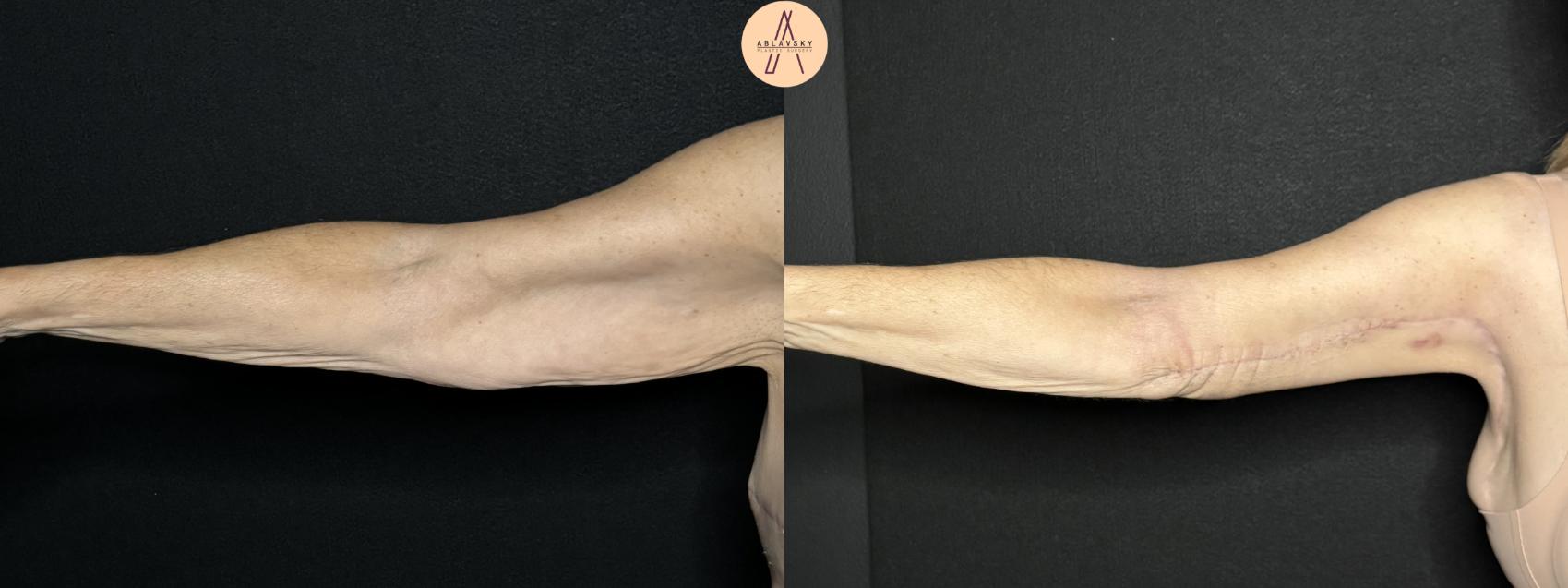 Before & After Arm Lift Case 281 Right Side View in San Antonio, Texas