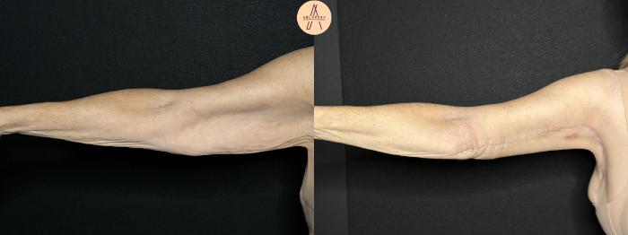 Before & After Arm Lift Case 281 Right Side View in San Antonio, Texas