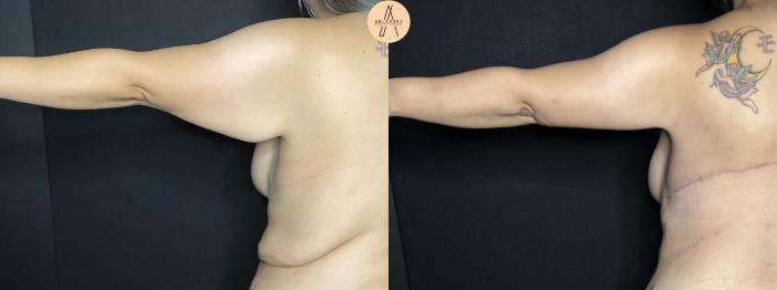 Before & After Arm Lift Case 283 Left Back View in San Antonio, Texas