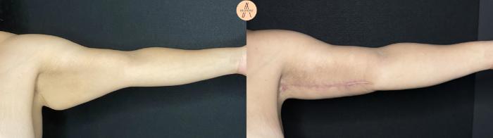 Before & After Arm Lift Case 283 Left Side View in San Antonio, Texas