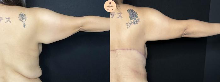 Before & After Arm Lift Case 283 Right Back View in San Antonio, Texas