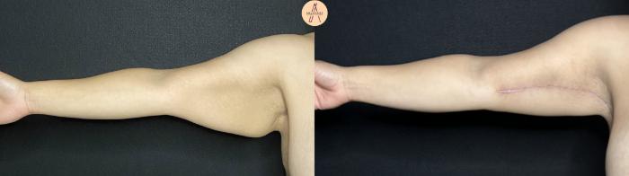 Before & After Arm Lift Case 283 Right Side View in San Antonio, Texas