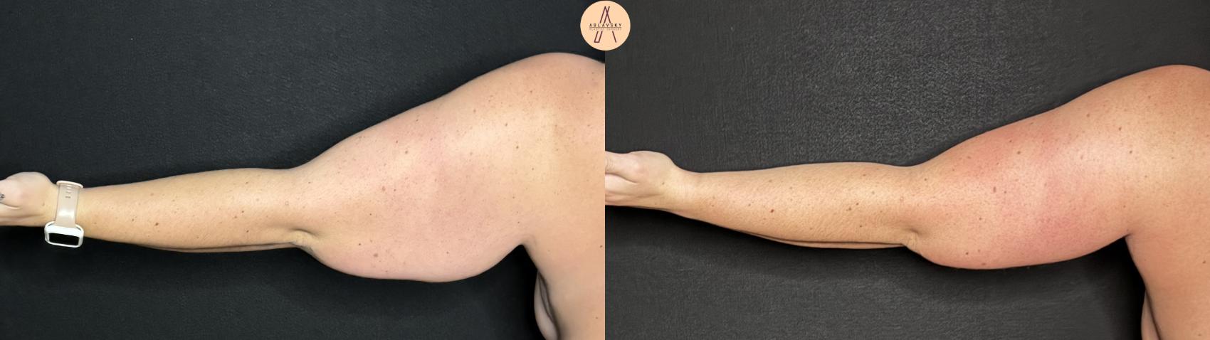 Before & After Arm Lift Case 331 Left Back View in San Antonio, Texas