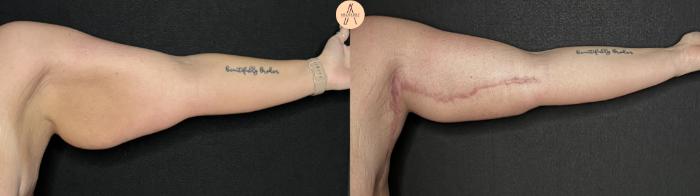 Before & After Arm Lift Case 331 Left Side View in San Antonio, Texas