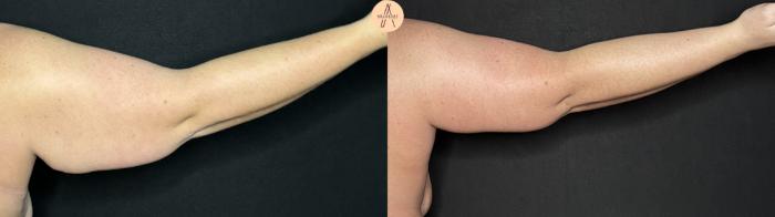 Before & After Arm Lift Case 331 Right Back View in San Antonio, Texas