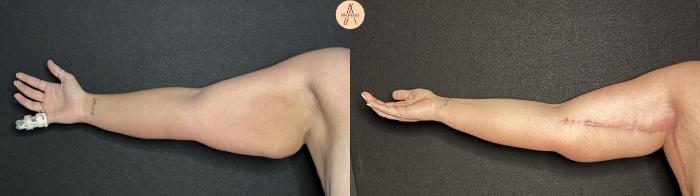 Before & After Arm Lift Case 331 Right Side View in San Antonio, Texas