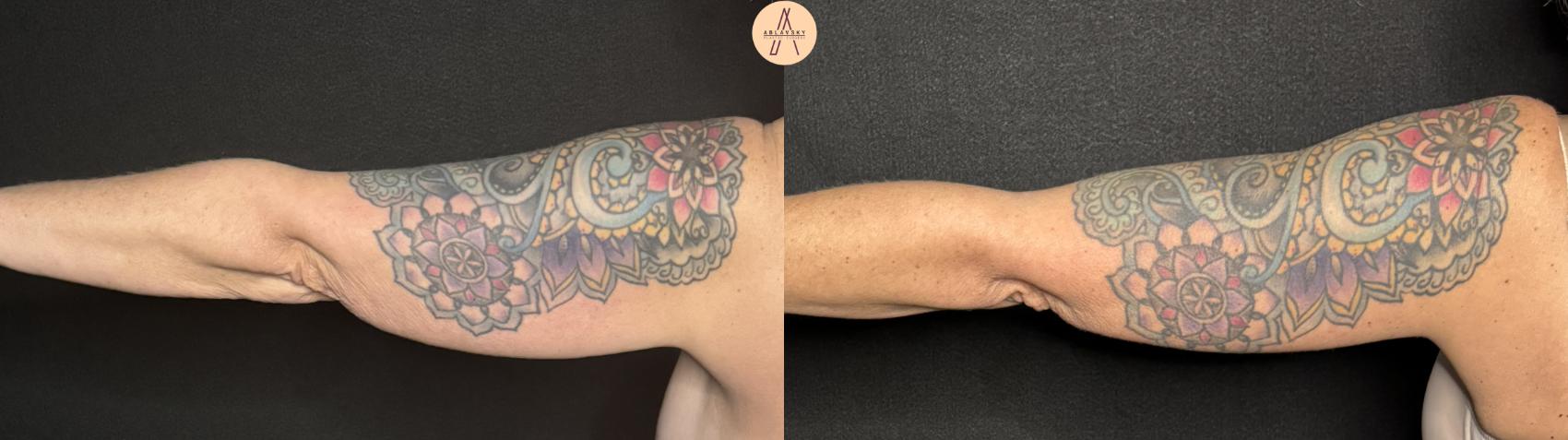 Before & After Arm Lift Case 336 Left Back View in San Antonio, Texas