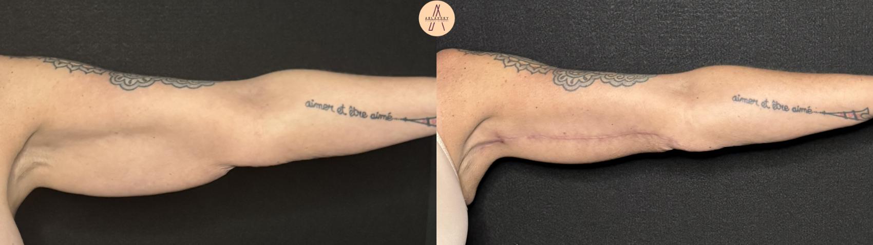 Before & After Arm Lift Case 336 Left Side View in San Antonio, Texas