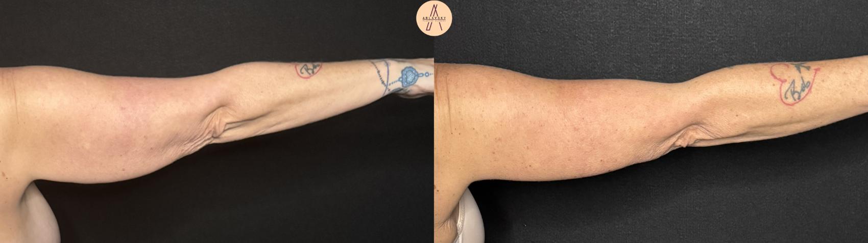 Before & After Arm Lift Case 336 Right Back View in San Antonio, Texas