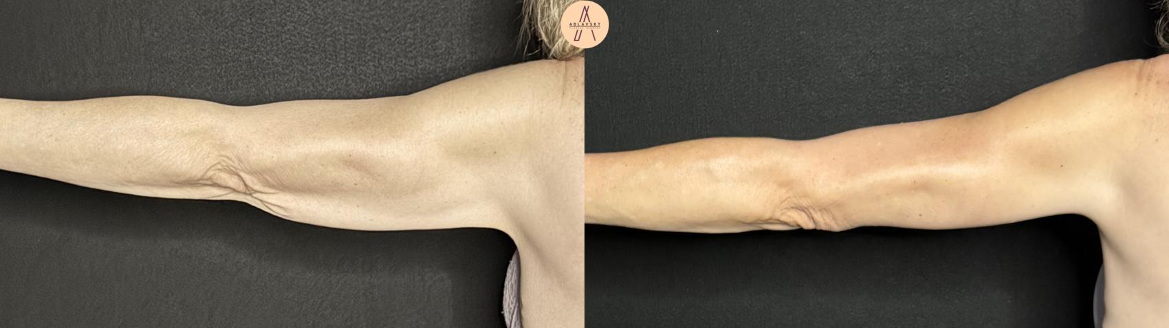 Before & After Arm Lift Case 357 Left Back View in San Antonio, Texas