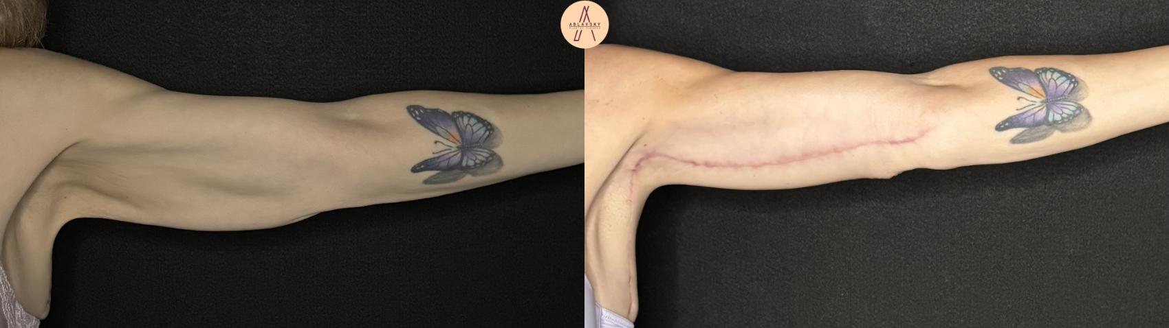 Before & After Arm Lift Case 357 Left Side View in San Antonio, Texas