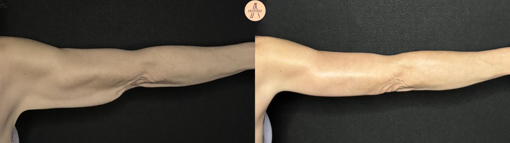 Before & After Arm Lift Case 357 Right Back View in San Antonio, Texas