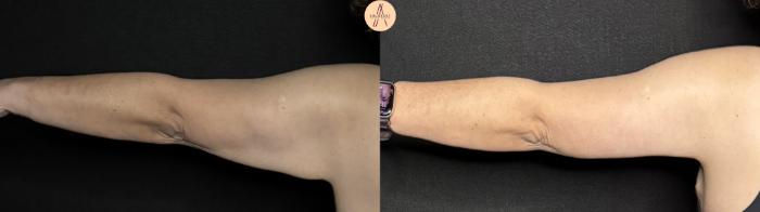 Before & After Arm Lift Case 374 Left Back View in San Antonio, Texas